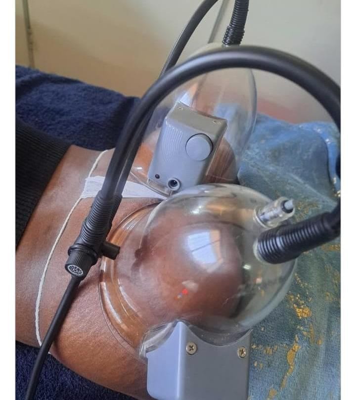 Breast & bum lift treatment at The Body Fix